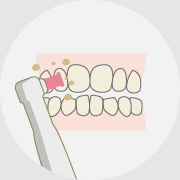 歯のクリーニングと自宅での使用法説明