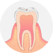 歯の表面に小さな虫歯ができます