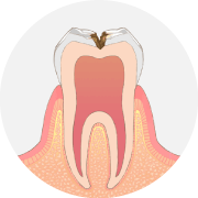 虫歯が神経に近づくと、冷たいものがしみます