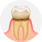歯と歯茎の間に歯垢がたまります